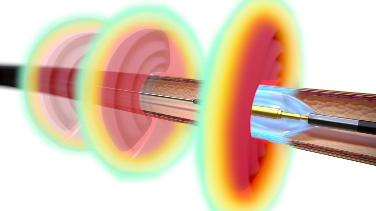 Recor Medical Supports Proposed CMS National Coverage Determination of Renal Denervation for the Treatment of Hypertension